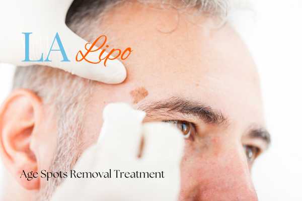 What Are the Most Effective Treatments for Age Spots Uppingham?