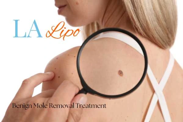 Woman having her inspection of blemish before mole removal Uppingham