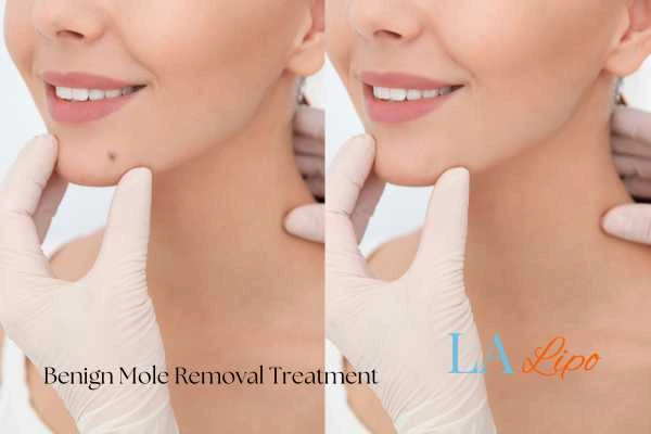 Before and after mole removal Uppingham treatment