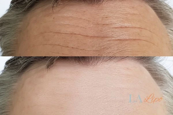 results of HIFU Uppingham on mans forehead to help reduce lines and wrinkles