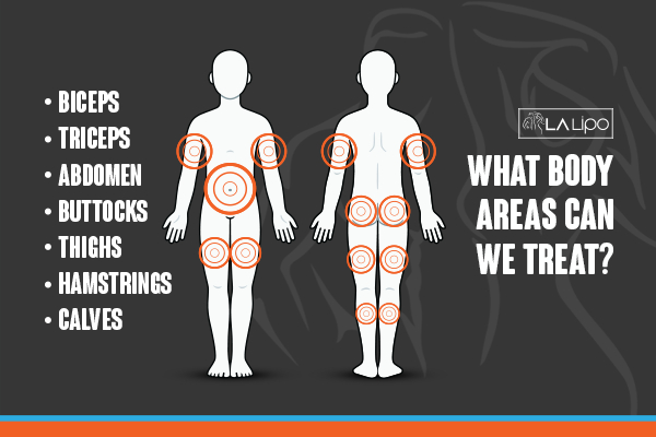 Graphic to show areas you can have LA-EMS Body Sculpting Uppingham treatment.