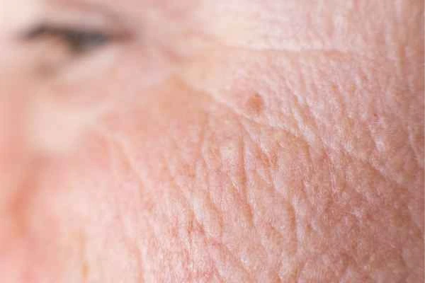 close up picture of a woman's face showing an age spot Uppingham