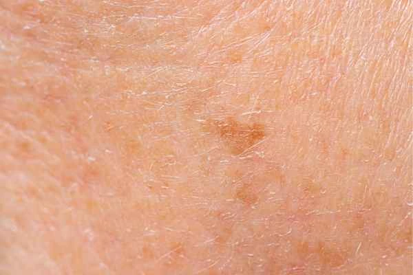 close up picture of age spots Uppingham