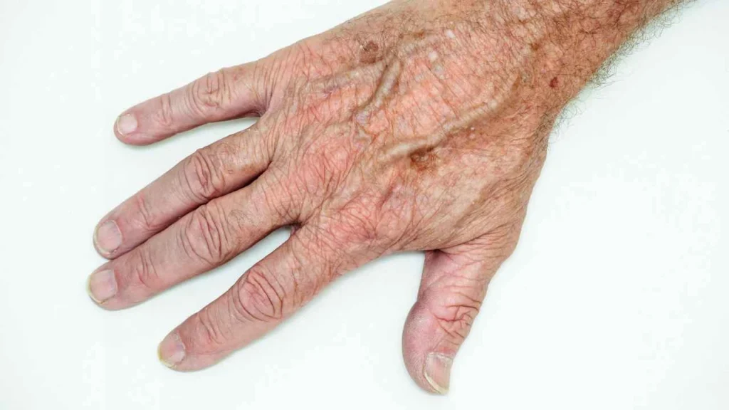 Male hand showing age spot Uppingham